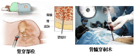 骨穿.jpg